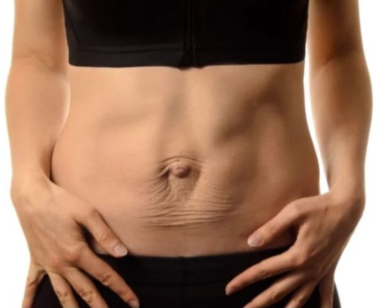 Illustrazione della diastasi dei retti dell'addome