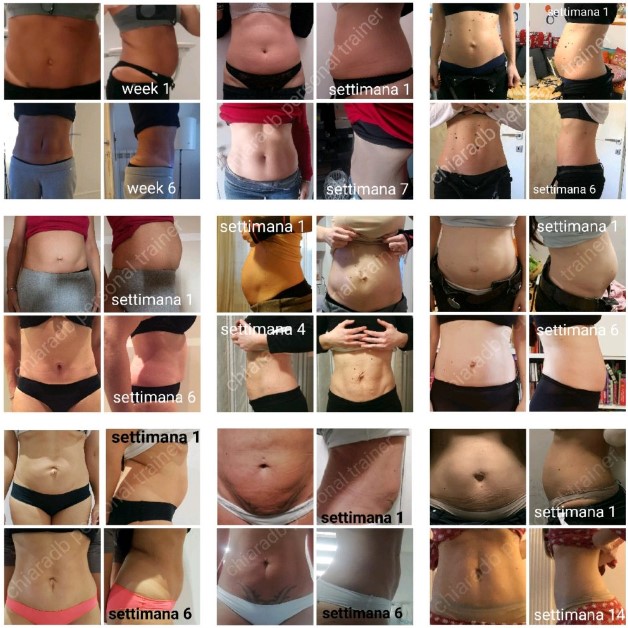 Risultati del trattamento della diastasi